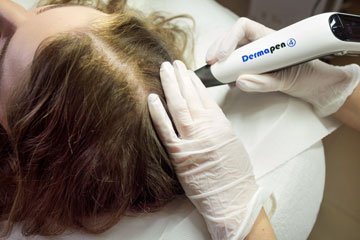 Zabieg Dermapen na włosy - umów się na zabieg